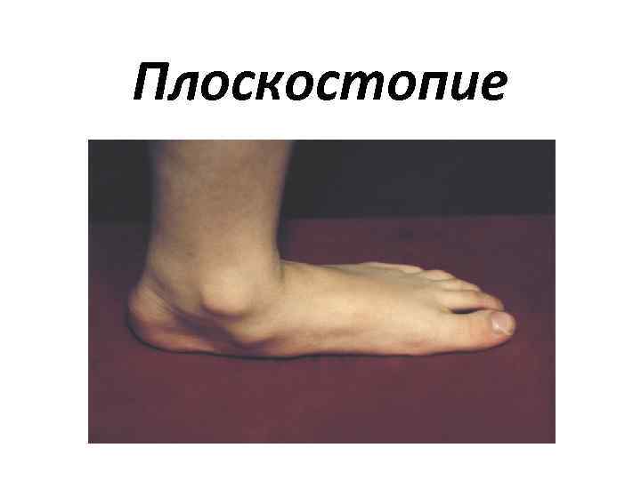 Плоскостопие 