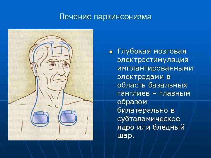 Лечение паркинсонизма n Глубокая мозговая электростимуляция имплантированными электродами в область базальных ганглиев – главным