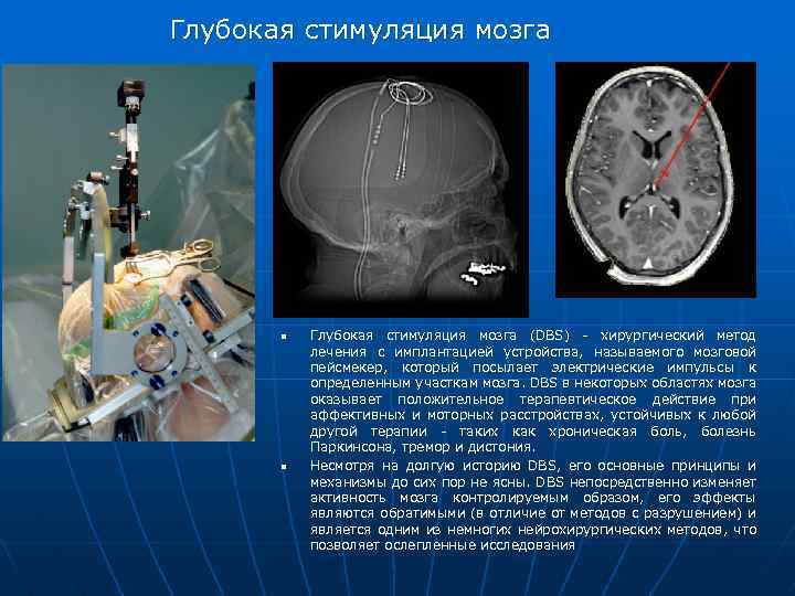 Глубокая стимуляция мозга n Глубокая стимуляция мозга (DBS) - хирургический метод лечения с имплантацией