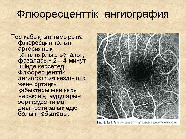 Флюоресценттік ангиография Тор қабықтың тамырына флюресцин толып, артериялық, капиллярлық, веналық фазаларын 2 – 4