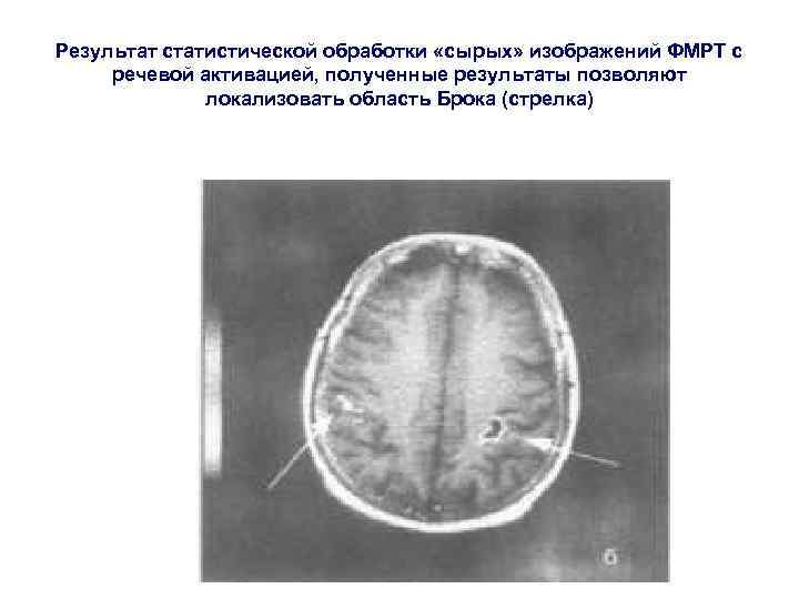 Результат статистической обработки «сырых» изображений ФМРТ с речевой активацией, полученные результаты позволяют локализовать область
