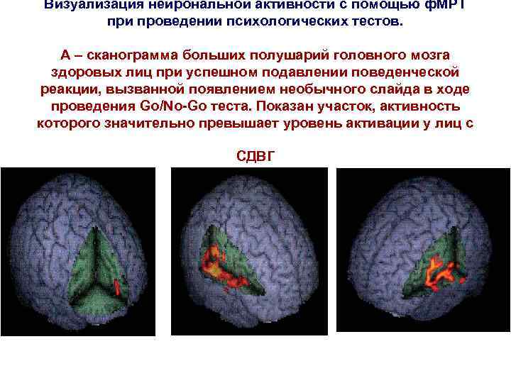 Визуализация нейрональной активности с помощью ф. МРТ при проведении психологических тестов. А – сканограмма