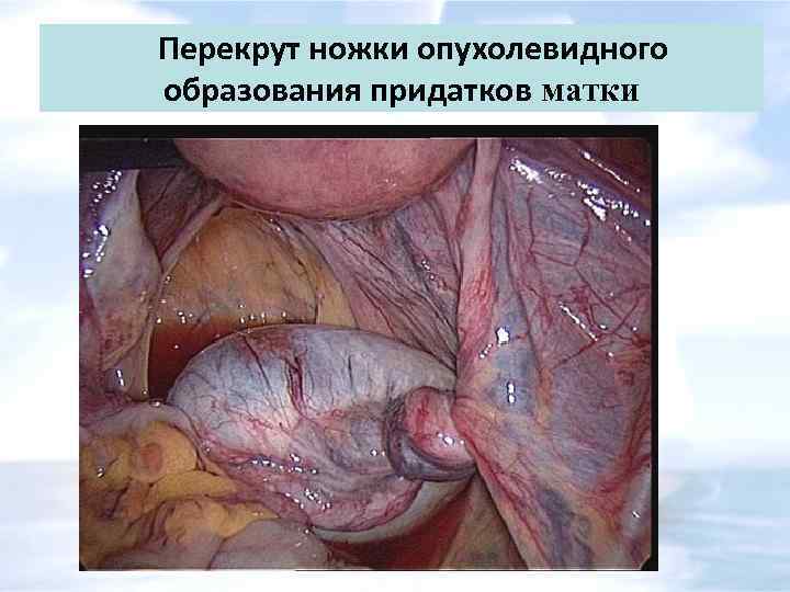 Перекрут ножки опухолевидного образования придатков матки 