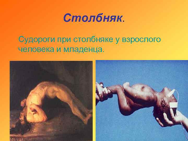 Столбняк. Судороги при столбняке у взрослого человека и младенца. 
