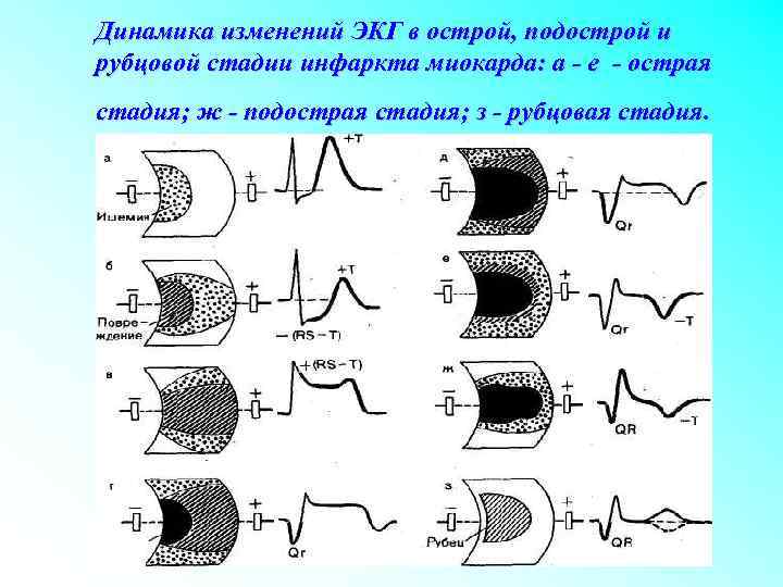 Динамика изменений ЭКГ в острой, подострой и рубцовой стадии инфаркта миокарда: а - е