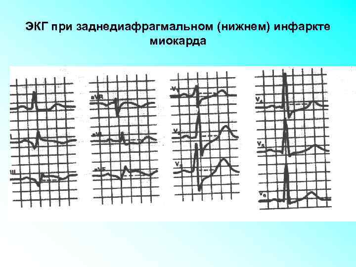 ЭКГ при заднедиафрагмальном (нижнем) инфаркте миокарда 
