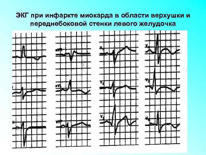 ЭКГ при инфаркте миокарда в области верхушки и переднебоковой стенки левого желудочка 