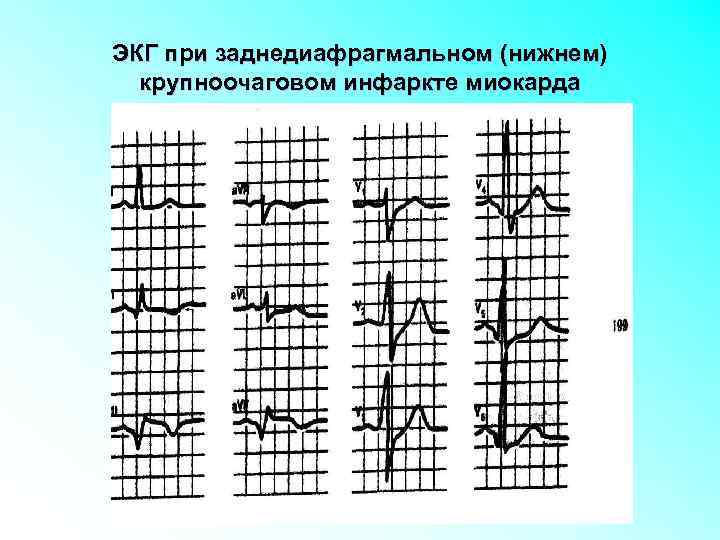 ЭКГ при заднедиафрагмальном (нижнем) крупноочаговом инфаркте миокарда 