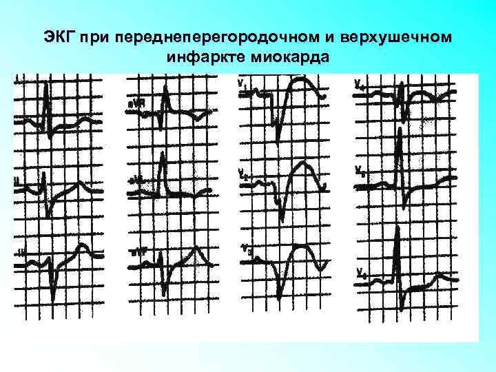 ЭКГ при переднеперегородочном и верхушечном инфаркте миокарда 