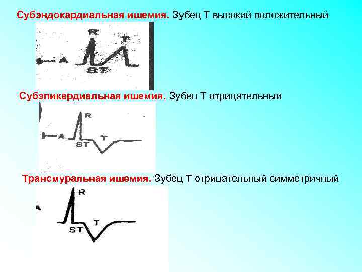 Субэндокардиальная ишемия. Зубец Т высокий положительный Субэпикардиальная ишемия. Зубец Т отрицательный Трансмуральная ишемия. Зубец