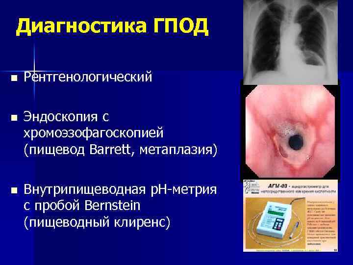 Диагностика ГПОД n Рентгенологический n Эндоскопия с хромоэзофагоскопией (пищевод Barrett, метаплазия) n Внутрипищеводная р.