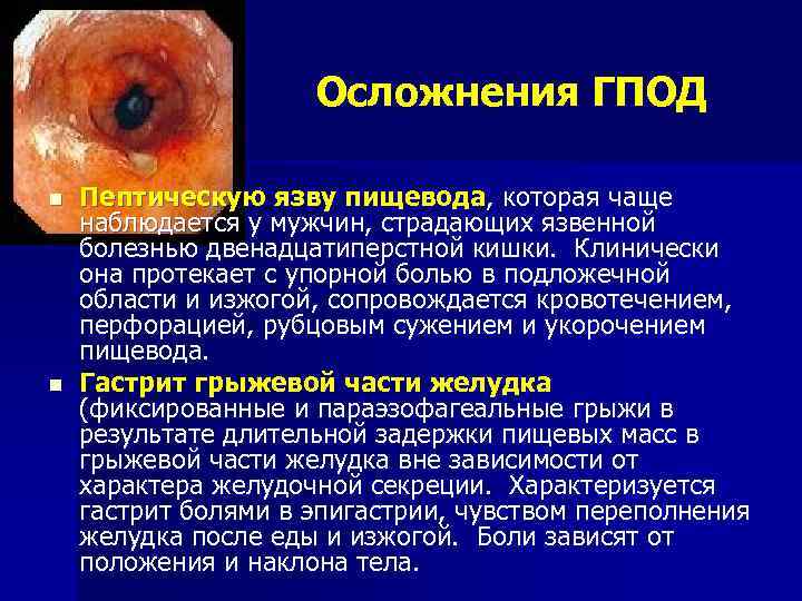 Осложнения ГПОД n n Пептическую язву пищевода, которая чаще наблюдается у мужчин, страдающих язвенной