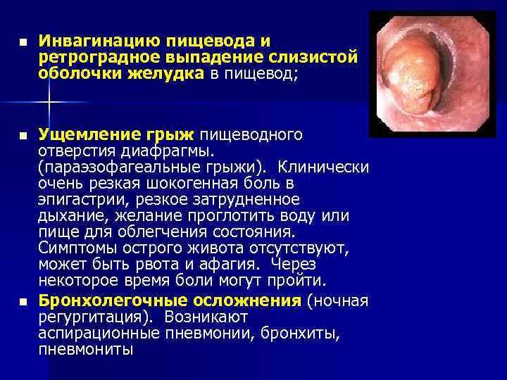 n Инвагинацию пищевода и ретроградное выпадение слизистой оболочки желудка в пищевод; n Ущемление грыж