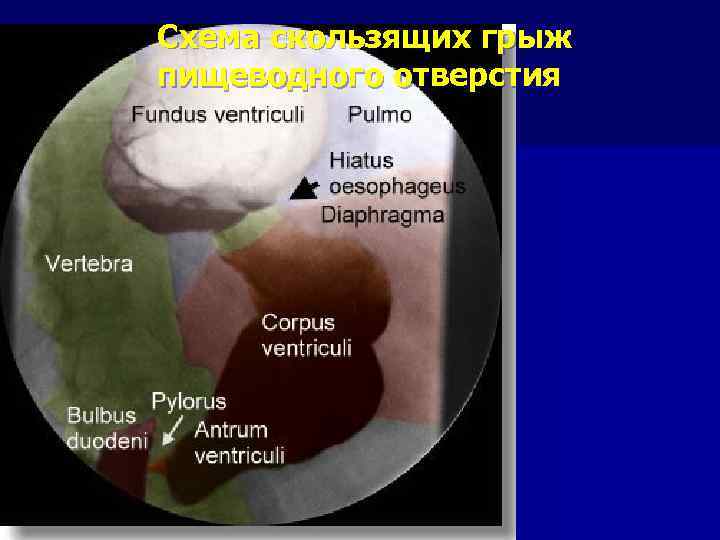 Схема скользящих грыж пищеводного отверстия 