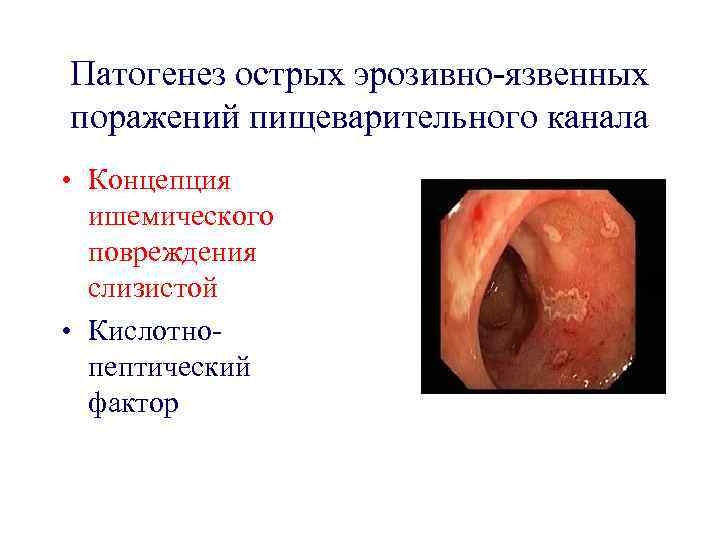 Патогенез острых эрозивно-язвенных поражений пищеварительного канала • Концепция ишемического повреждения слизистой • Кислотнопептический фактор