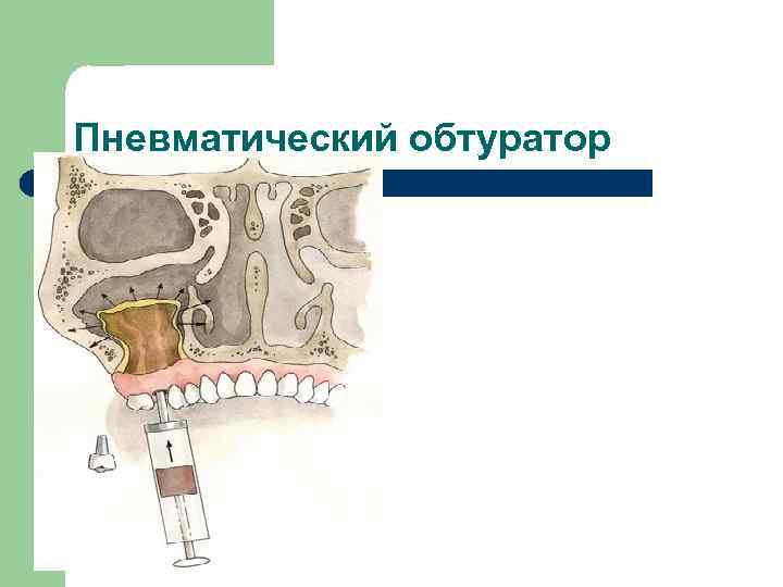 Пневматический обтуратор 