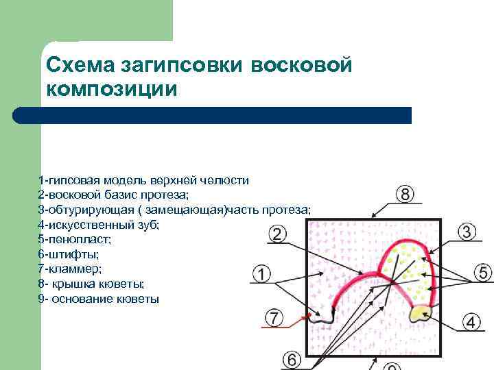 Схема загипсовки восковой композиции 1 гипсовая модель верхней челюсти 2 восковой базис протеза; 3