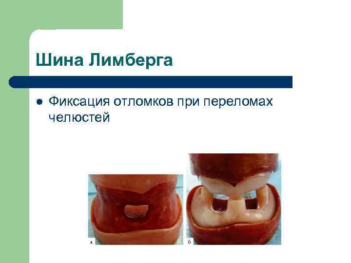 Шина Лимберга l Фиксация отломков при переломах челюстей 