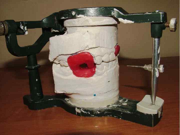 Актуальность l l Ортопедическая помощь в лечении у больных с дефектами верхней челю сти