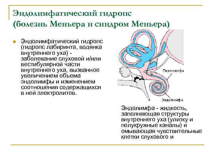 Эндолимфатический гидропс (болезнь Меньера и синдром Меньера) n Эндолимфатический гидропс (гидропс лабиринта, водянка внутреннего