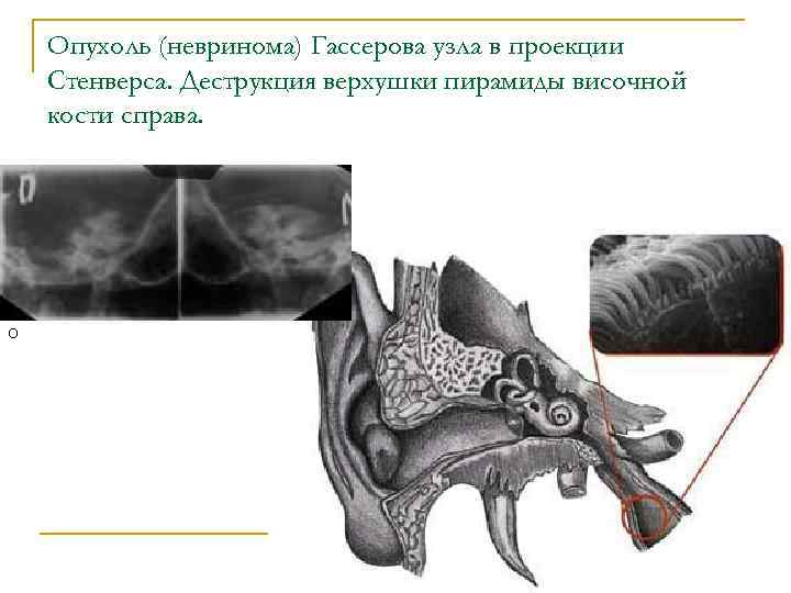 Опухоль (невринома) Гассерова узла в проекции Стенверса. Деструкция верхушки пирамиды височной кости справа. О