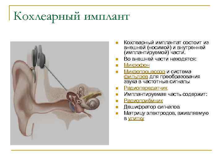 Кохлеарный имплант n n n n n Кохлеарный имплантат состоит из внешней (носимой) и