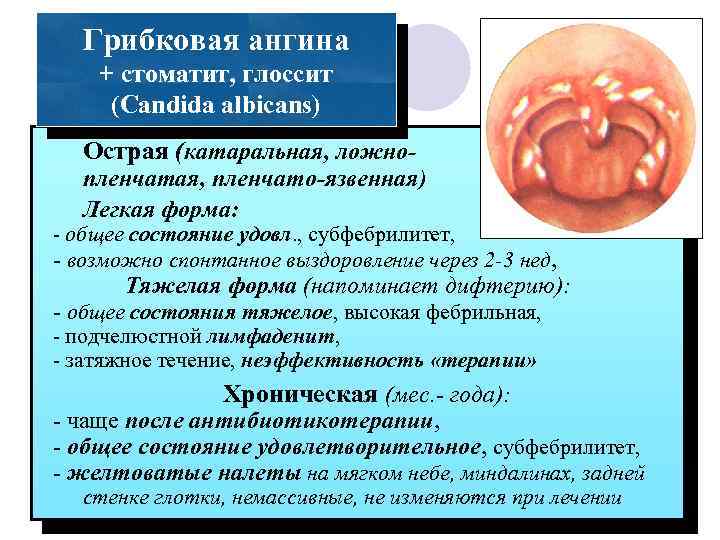 Грибковая ангина + стоматит, глоссит (Candida albicans) Острая (катаральная, ложно- пленчатая, пленчато-язвенная) Легкая форма: