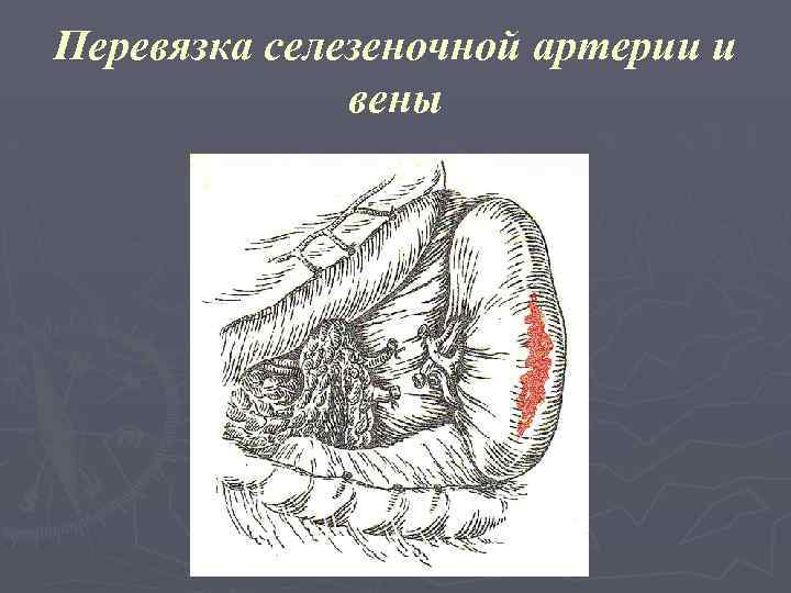 Перевязка селезеночной артерии и вены 