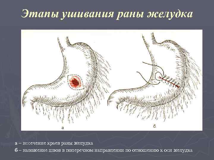 Этапы ушивания раны желудка а – иссечение краев раны желудка б – наложение швов