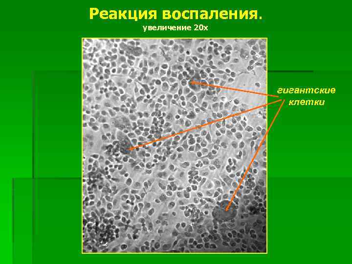 Реакция воспаления. увеличение 20 х гигантские клетки 
