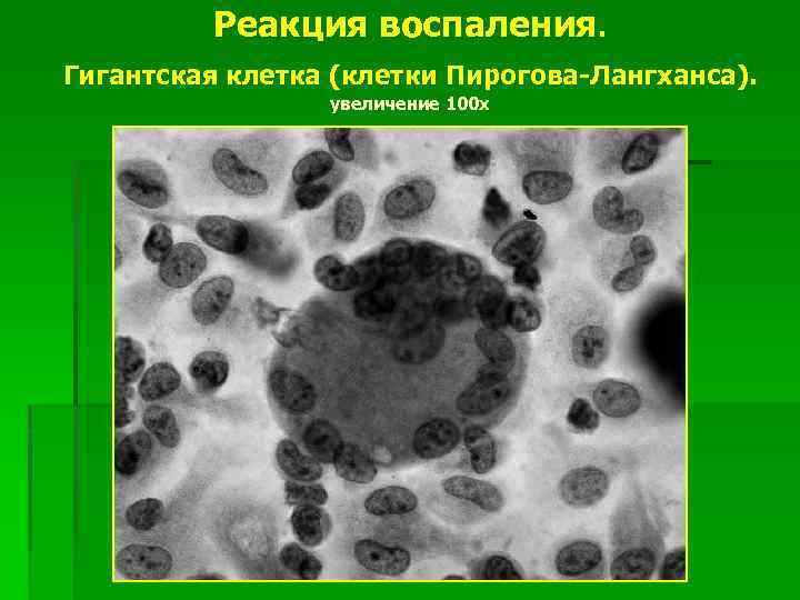 Реакция воспаления. Гигантская клетка (клетки Пирогова-Лангханса). увеличение 100 х 