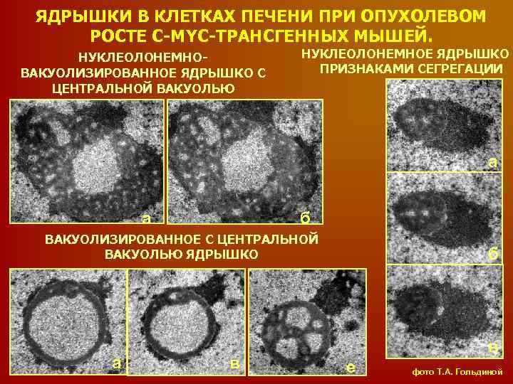 ЯДРЫШКИ В КЛЕТКАХ ПЕЧЕНИ ПРИ ОПУХОЛЕВОМ РОСТЕ C-MYC-ТРАНСГЕННЫХ МЫШЕЙ. НУКЛЕОЛОНЕМНОВАКУОЛИЗИРОВАННОЕ ЯДРЫШКО С ЦЕНТРАЛЬНОЙ ВАКУОЛЬЮ