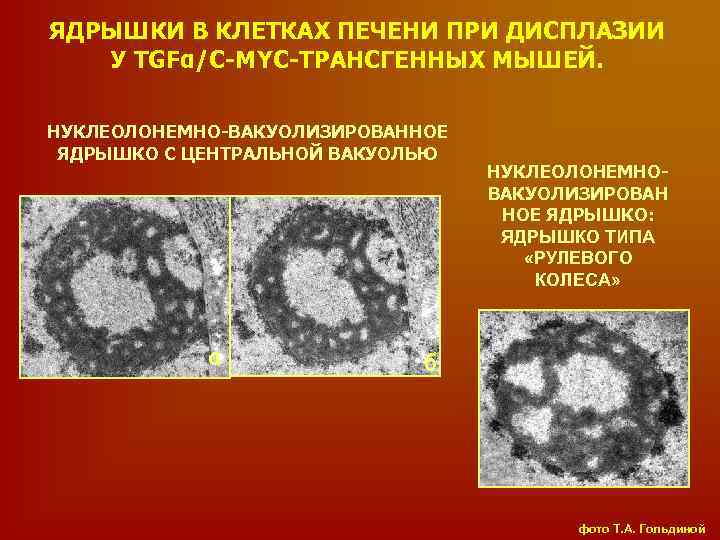 ЯДРЫШКИ В КЛЕТКАХ ПЕЧЕНИ ПРИ ДИСПЛАЗИИ У TGFα/C-MYC-ТРАНСГЕННЫХ МЫШЕЙ. НУКЛЕОЛОНЕМНО-ВАКУОЛИЗИРОВАННОЕ ЯДРЫШКО С ЦЕНТРАЛЬНОЙ ВАКУОЛЬЮ