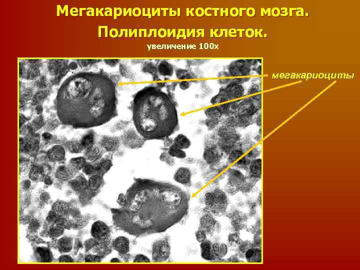 Мегакариоциты костного мозга. Полиплоидия клеток. увеличение 100 х мегакариоциты 