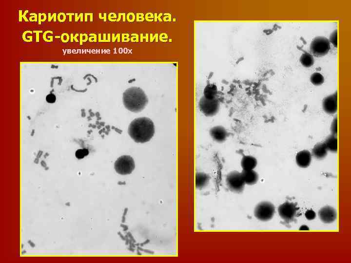 Кариотип человека. GTG-окрашивание. увеличение 100 х 