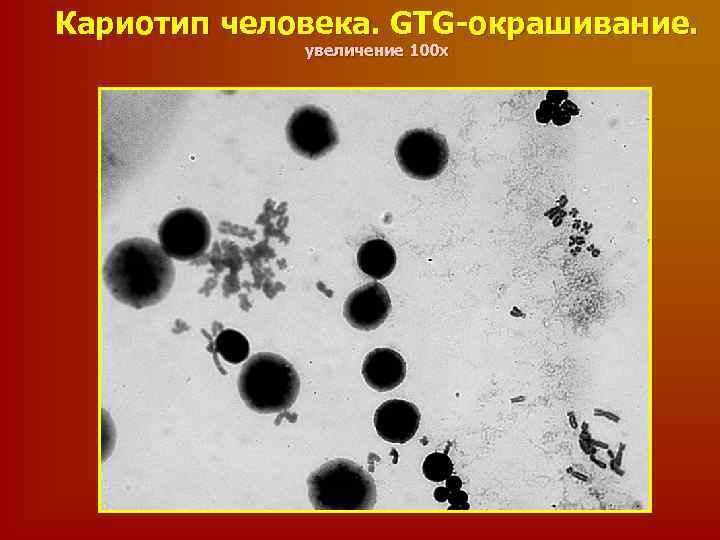 Кариотип человека. GTG-окрашивание. увеличение 100 х 