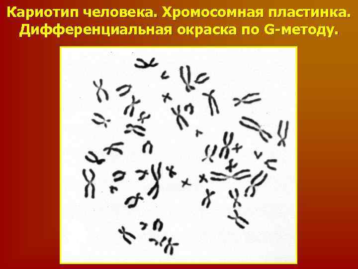Кариотип человека. Хромосомная пластинка. Дифференциальная окраска по G-методу. 