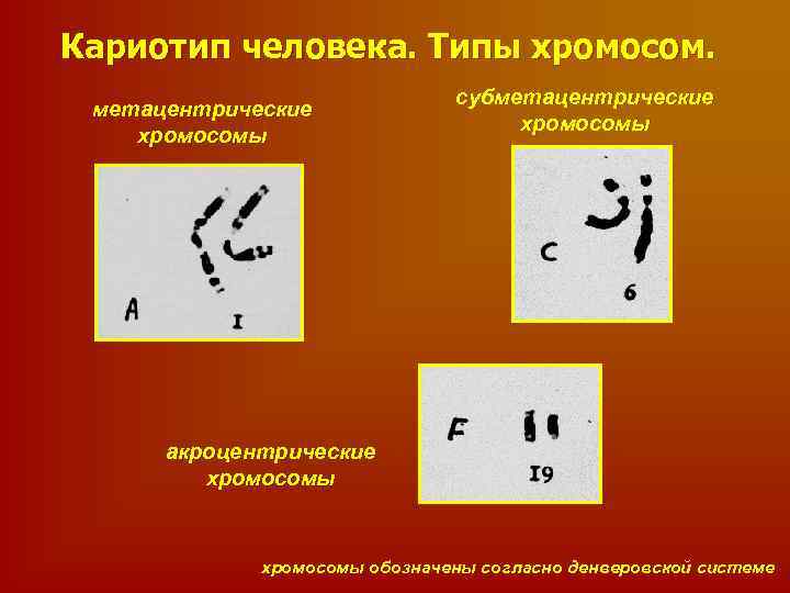 Кариотип человека. Типы хромосом. метацентрические хромосомы субметацентрические хромосомы акроцентрические хромосомы обозначены согласно денверовской системе
