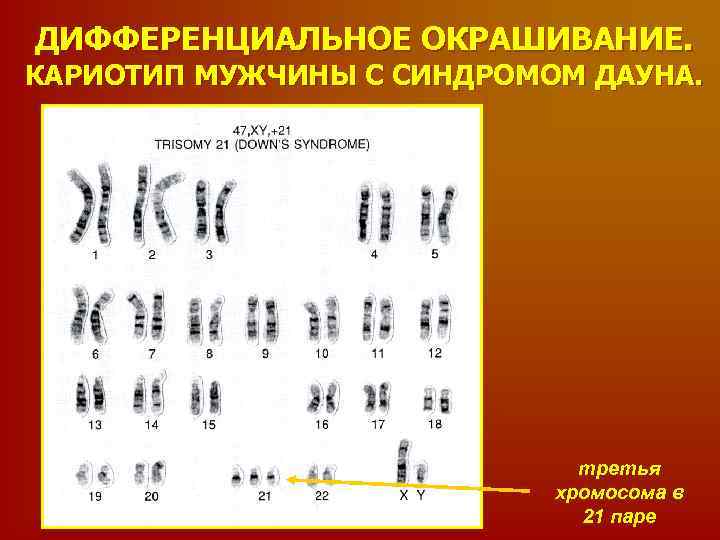 Количество хромосом в кариотипе человека. Кариограмма синдрома Дауна. Кариограмма синдрома Эдвардса. Кариотип мужчины с синдромом Дауна. Формула кариотипа при синдроме Дауна.
