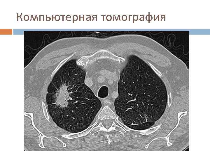 Компьютерная томография 