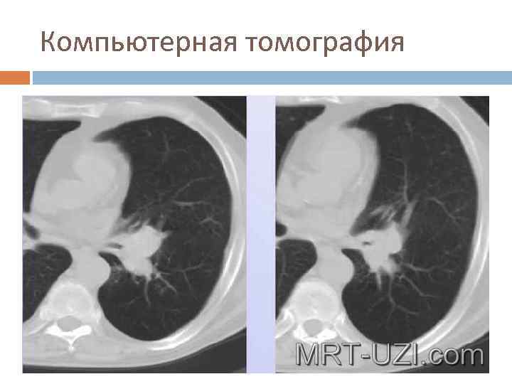 Компьютерная томография 