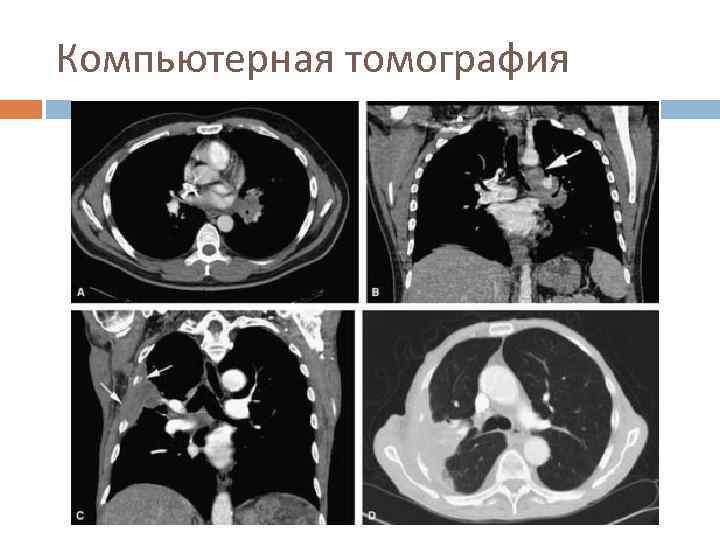 Компьютерная томография 