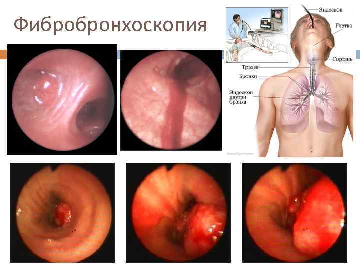 Фибробронхоскопия 