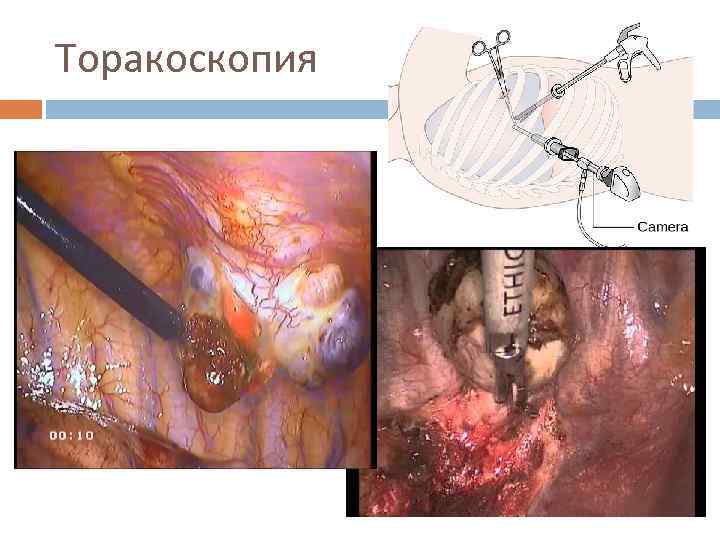 Торакоскопия 