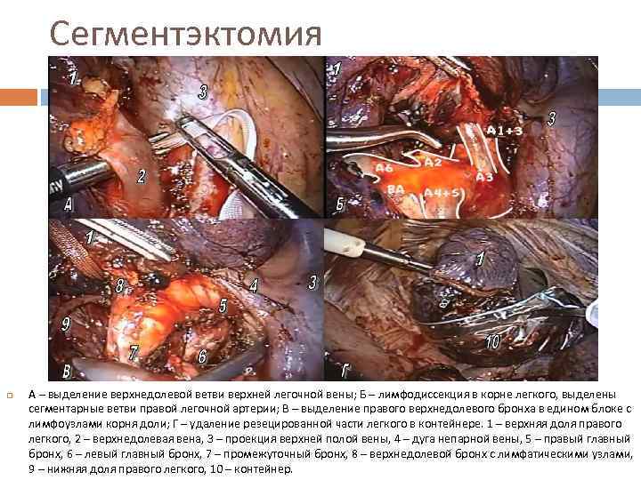 Сегментэктомия А – выделение верхнедолевой ветви верхней легочной вены; Б – лимфодиссекция в корне