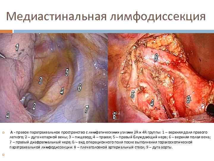 Медиастинальная лимфодиссекция А - правое паратрахеальное пространство с лимфатическими узлами 2 R и 4