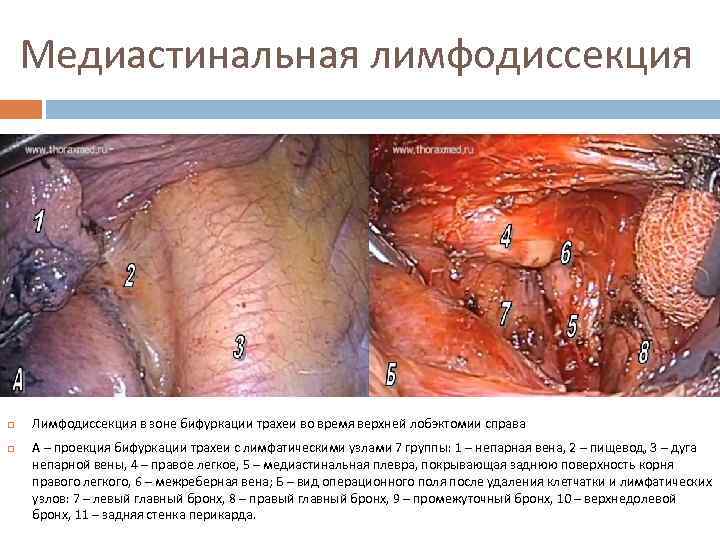 Медиастинальная лимфодиссекция Лимфодиссекция в зоне бифуркации трахеи во время верхней лобэктомии справа А –