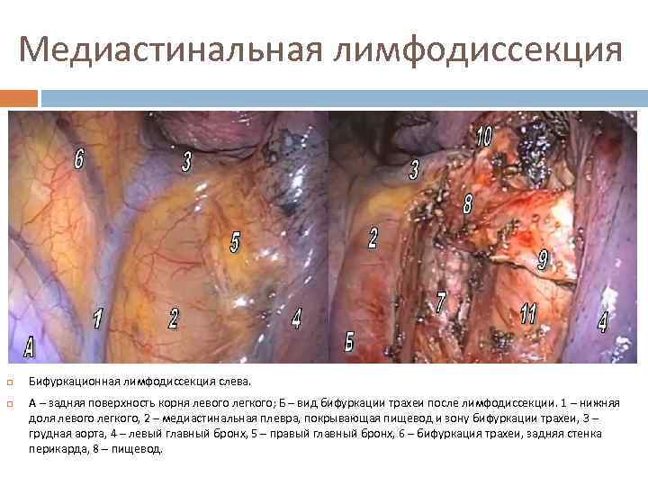 Медиастинальная лимфодиссекция Бифуркационная лимфодиссекция слева. А – задняя поверхность корня левого легкого; Б –