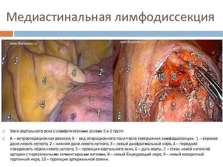 Медиастинальная лимфодиссекция Зона аортального окна с лимфатическими узлами 5 и 6 групп. А –
