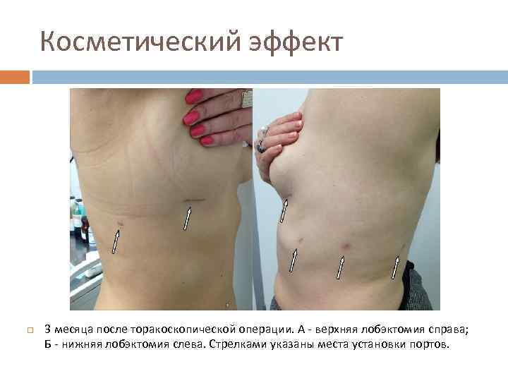 Косметический эффект 3 месяца после торакоскопической операции. А - верхняя лобэктомия справа; Б -